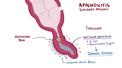 why does appendicitis cause anorexia